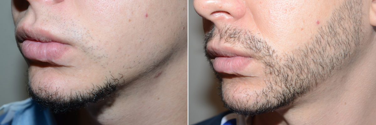 Facial Hair Before and after in Miami, FL, Paciente 98719