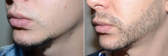 Facial Hair Transplant Before and after in Miami, FL, Paciente 98719