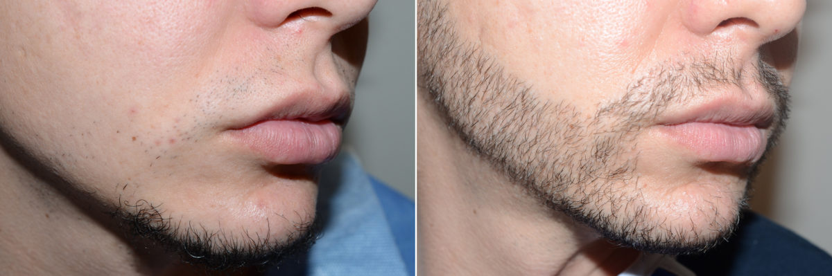 Facial Hair Transplant Before and after in Miami, FL, Paciente 98719