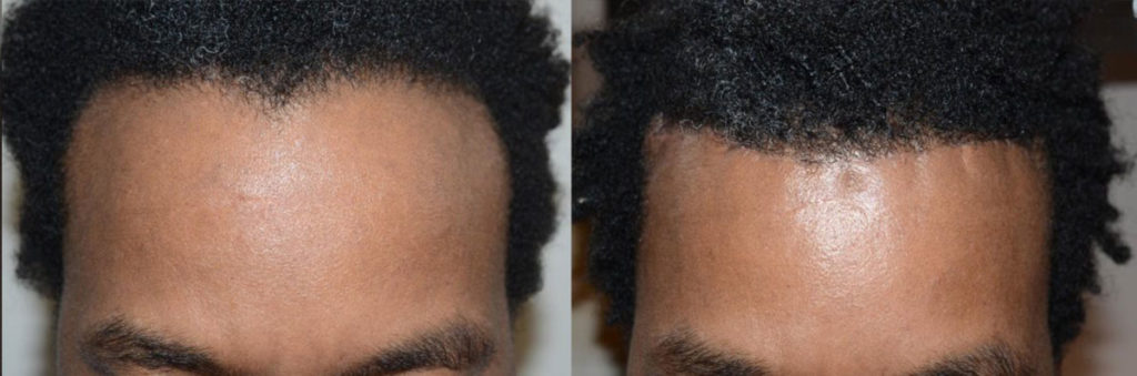 Antes y una semana después de la cirugía de reducción de la línea del cabello.