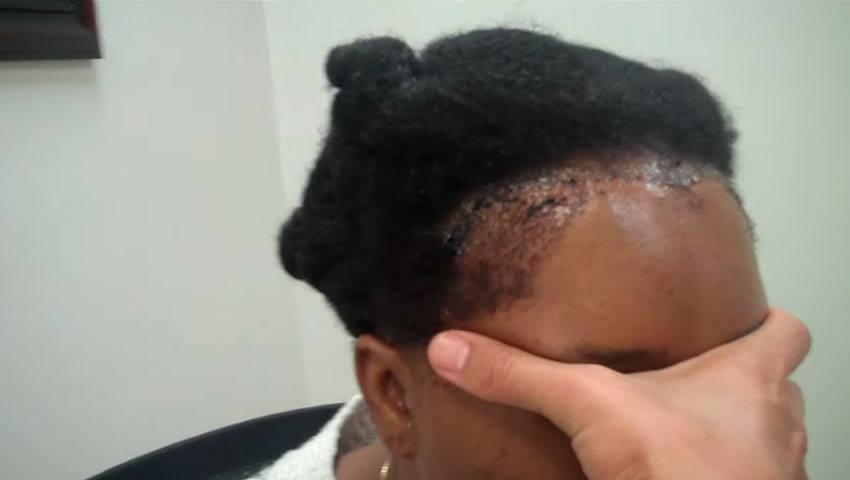 African Hair Loss Miami Ethnic Hair Restoration In Fl Dr Epstein