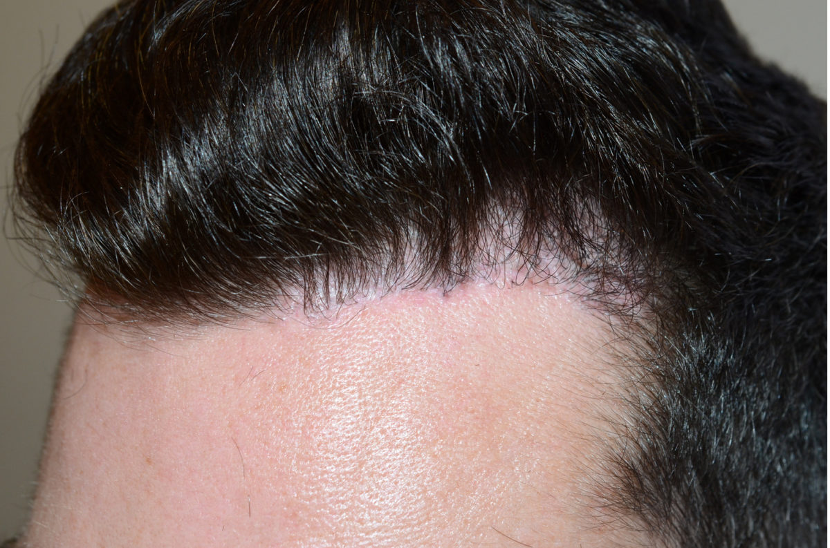 Reparative Hair Transplant Before and after in Miami, FL, Paciente 94901