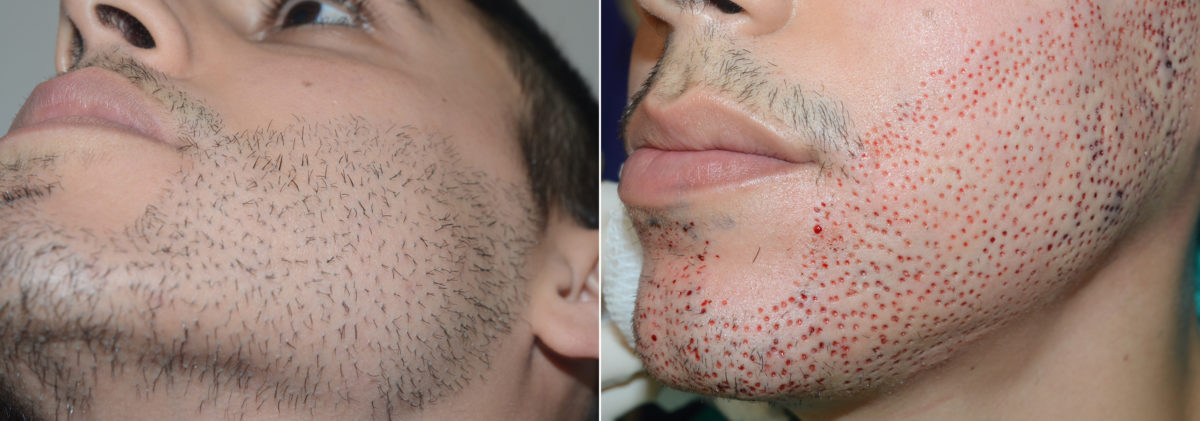 Reparative Hair Transplant Before and after in Miami, FL, Paciente 94902