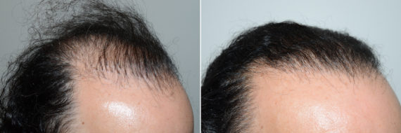 Reparative Hair Transplant Before and after in Miami, FL, Paciente 98737