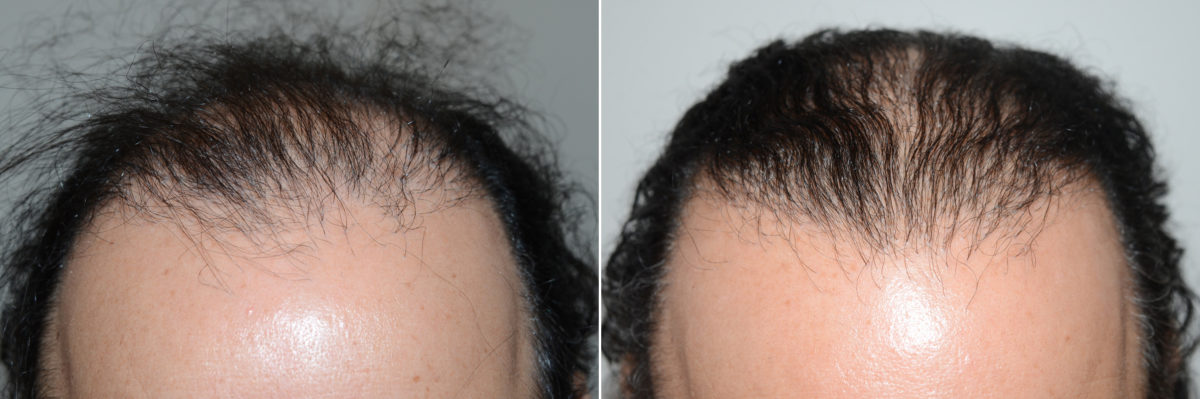 Reparative Hair Transplant Before and after in Miami, FL, Paciente 98737