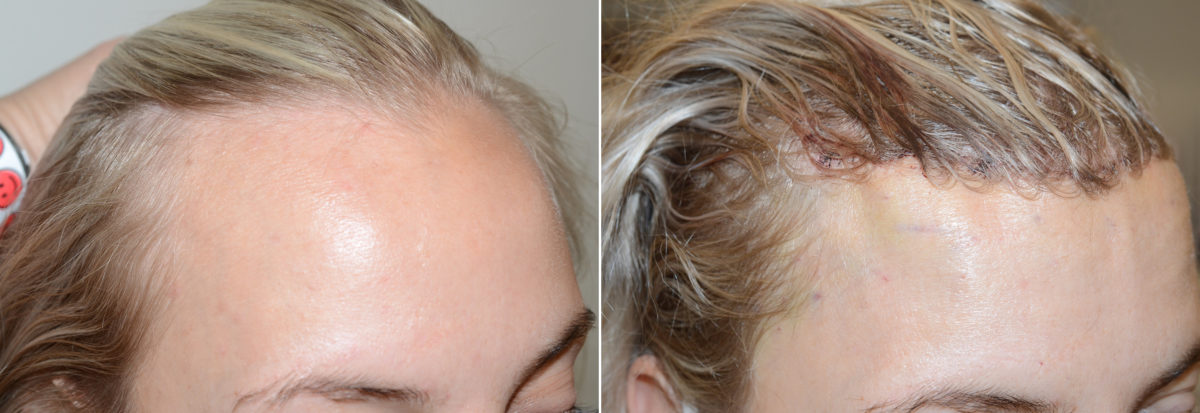 Forehead Reduction Surgery Before and after in Miami, FL, Paciente 107738