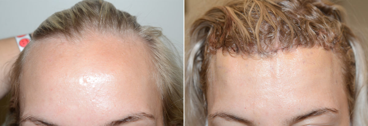 Hairline Advancement Before and after in Miami, FL, Paciente 107738
