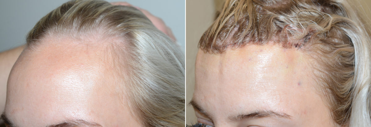Forehead Reduction Surgery Before and after in Miami, FL, Paciente 107738