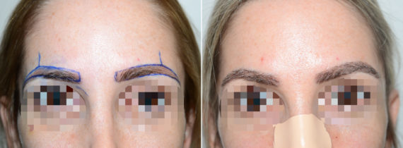 Eyebrow Hair Transplant Before and after in Miami, FL, Paciente 108237