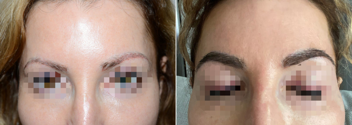 Eyebrow Hair Transplant Before and after in Miami, FL, Paciente 108135