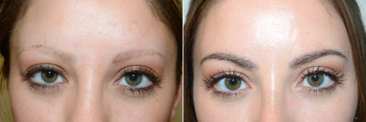 Eyebrow Hair Transplant Before and after in Miami, FL, Paciente 108278