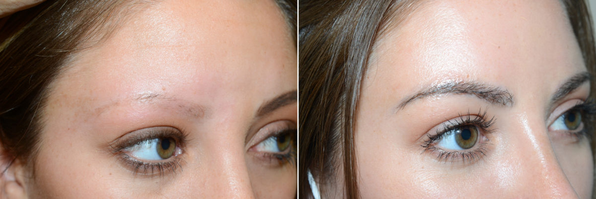 Eyebrow Before and after in Miami, FL, Paciente 108278
