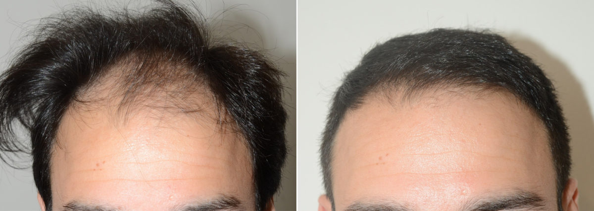 Hair Transplants for Men Before and after in Miami, FL, Paciente 107965
