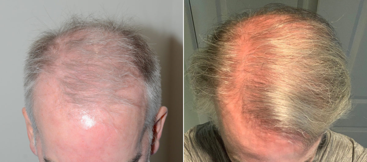 Hair Transplants for Men Before and after in Miami, FL, Paciente 108331