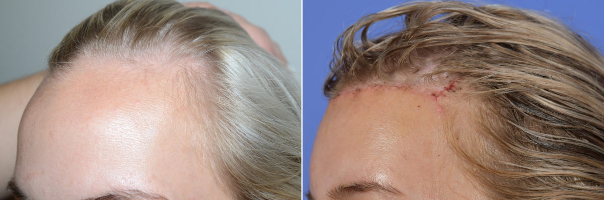 Hairline Transplant Closeups Before and after in Miami, FL, Paciente 107836