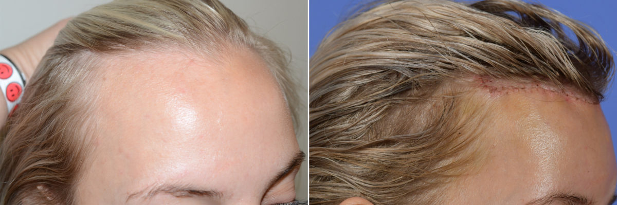 Hairline Transplant Closeups Before and after in Miami, FL, Paciente 107836