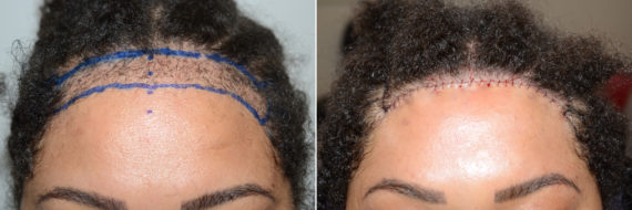 Hairline Transplant Closeups Before and after in Miami, FL, Paciente 108296