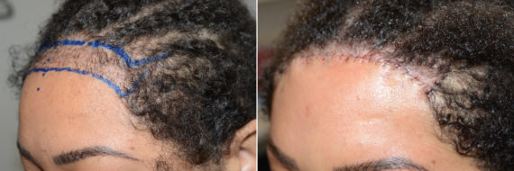 Hairline Closeups Before and after in Miami, FL, Paciente 108296