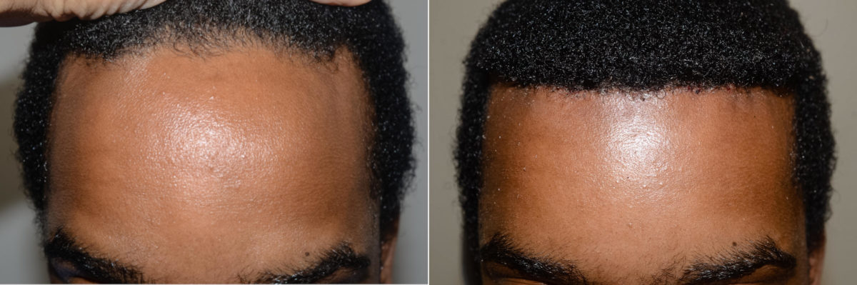 Hairline Advancement Before and after in Miami, FL, Paciente 58039