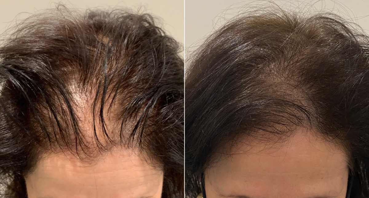 Scalp Micropigmentation Before and after in Miami, FL, Paciente 94629