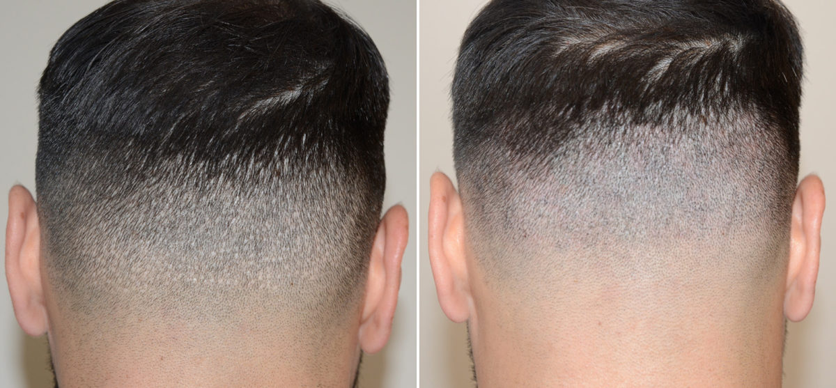 Reparative Hair Transplant Before and after in Miami, FL, Paciente 108189