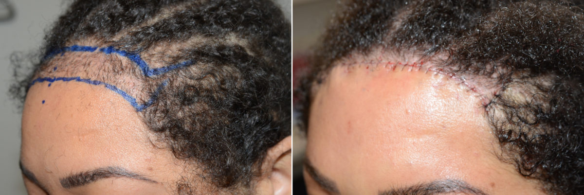 Reparative Before and after in Miami, FL, Paciente 108297