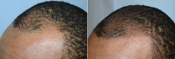 Scalp Micropigmentation Before and after in Miami, FL, Paciente 108044