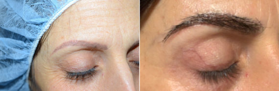 Eyebrow Before and after in Miami, FL, Paciente 108448