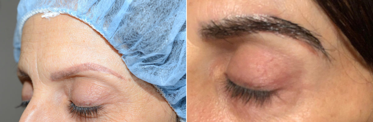 Eyebrow Hair Transplant Before and after in Miami, FL, Paciente 108448