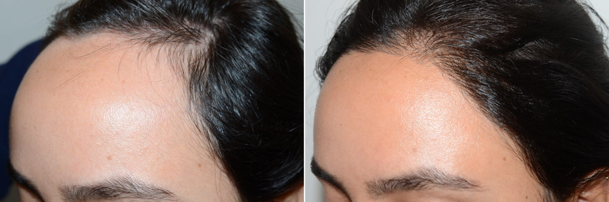 Hair Transplants for Women Before and after in Miami, FL, Paciente 108512