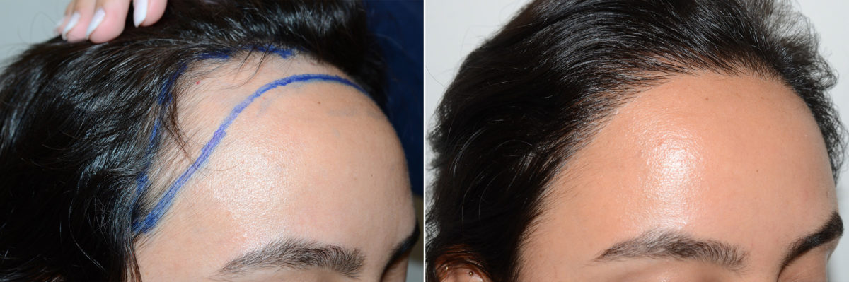 Forehead Reduction Surgery Before and after in Miami, FL, Paciente 108512