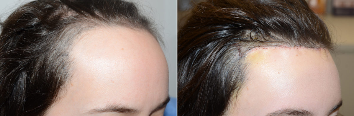 Hairline Advancement Before and after in Miami, FL, Paciente 108377