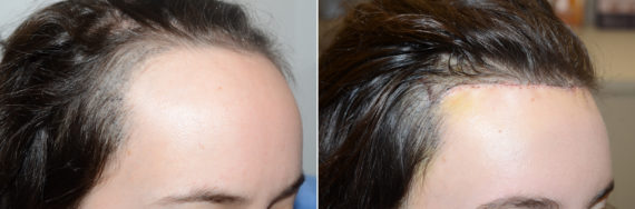 Forehead Reduction Surgery Before and after in Miami, FL, Paciente 108377