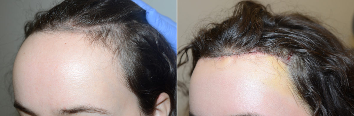 Hairline Advancement Before and after in Miami, FL, Paciente 108377