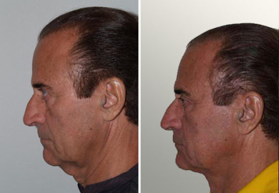 Combo Procedures Before and after in Miami, FL, Paciente 35191