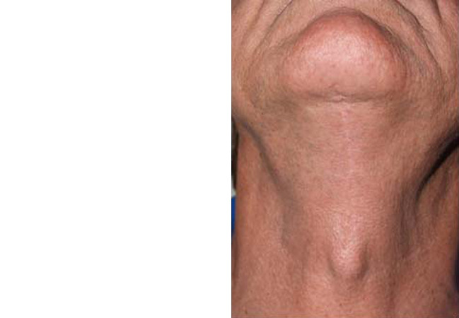 Combo Procedures Before and after in Miami, FL, Paciente 35191