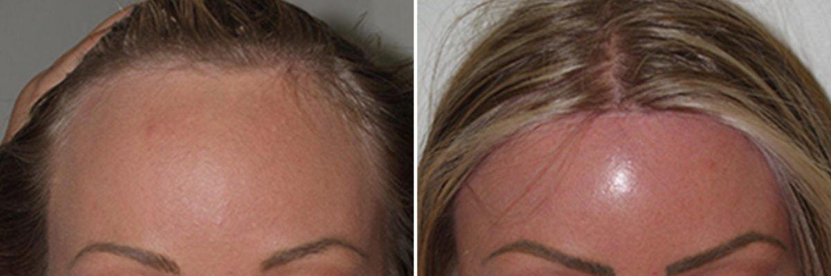 Hairline Advancement Before and after in Miami, FL, Paciente 37056