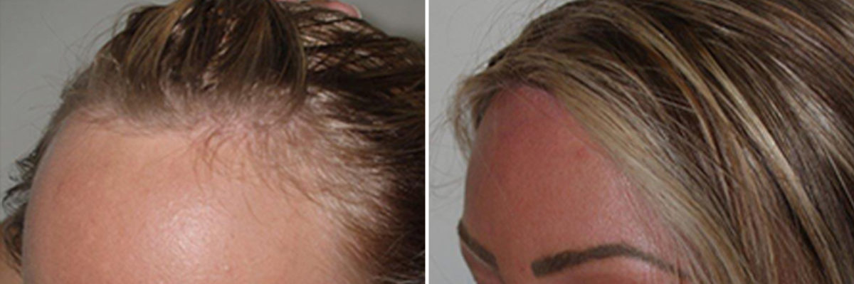 Forehead Reduction Surgery Before and after in Miami, FL, Paciente 37056