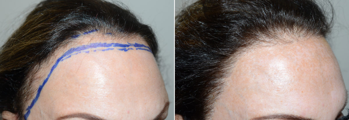 Hair Transplants for Women Before and after in Miami, FL, Paciente 108716