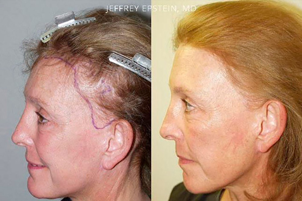 Facelift Scar Repair | Miami Repair Facelift Scarring | Hair Restoration