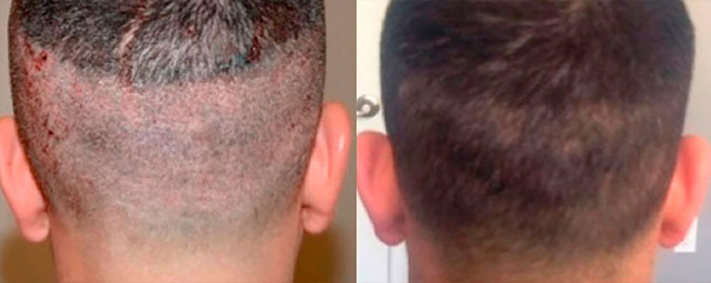 Neograft Hair Transplant Miami | Neograft Hair Restoration