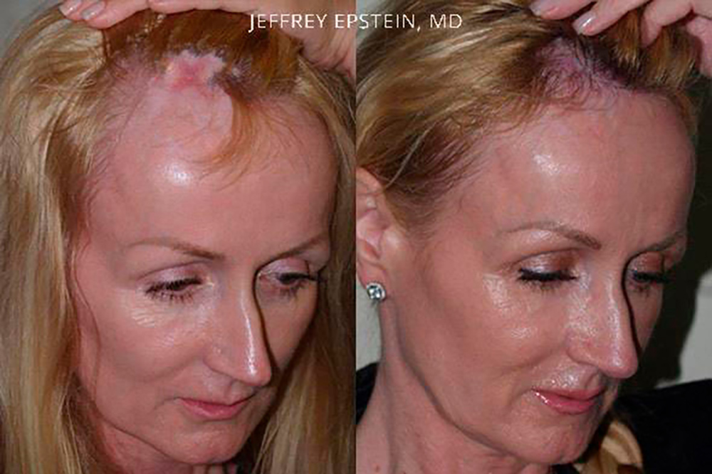 Reparative Hair Procedure | Miami Reparative Hairline Surgery