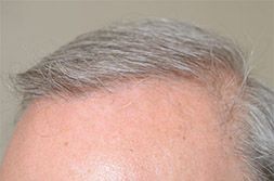 Trasplantando más de 3000 pelos de la espalda de un paciente masculino, el Dr. Epstein fue capaz de lograr en sólo 8 meses - Oblicue View After