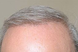 Transplanting over 3000 hairs from the back of a male patient, Dr. Epstein was able to achieve at just 8 months - Front view after