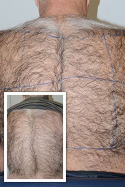 Trasplantando más de 3000 pelos de la espalda de un paciente masculino, el Dr. Epstein fue capaz de lograr en sólo 8 meses