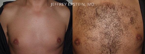 Antes y después de un procedimiento de 1.900 injertos en el pecho.