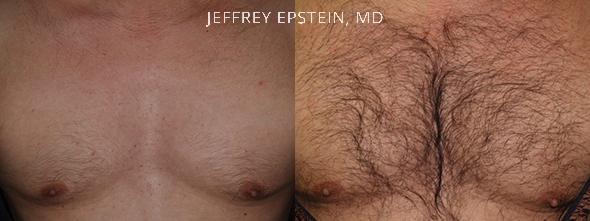Antes y después de un procedimiento de 2.200 injertos en el pecho.