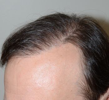 Vista oblicua Después del procedimiento reparador de BHT usando pelos de donantes de tórax y barba
