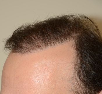 Vista oblicua del antes de BHT procedimiento reparador usando pelos de donantes de tórax y barba