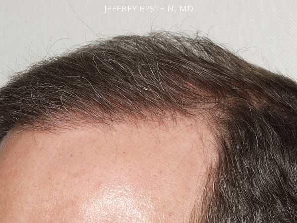 Close Up Hair Transplant Photos Patient 1